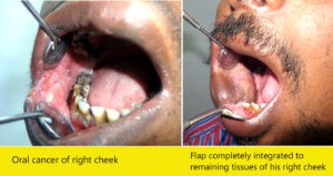 oral cancer treatment in India