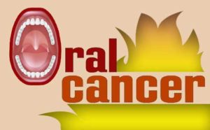 oral cancer treatment in Nagercoil