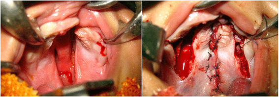 palatoplasty surgery in India