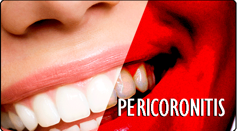 pericoronitis Treatment in India