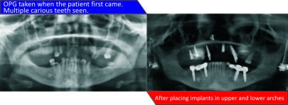 pre-and-post-implant-based-overdenture