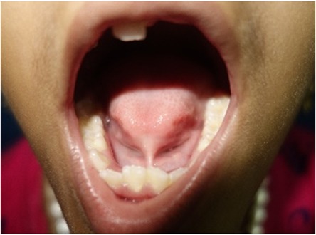 tongue tie treatment in Nagercoil