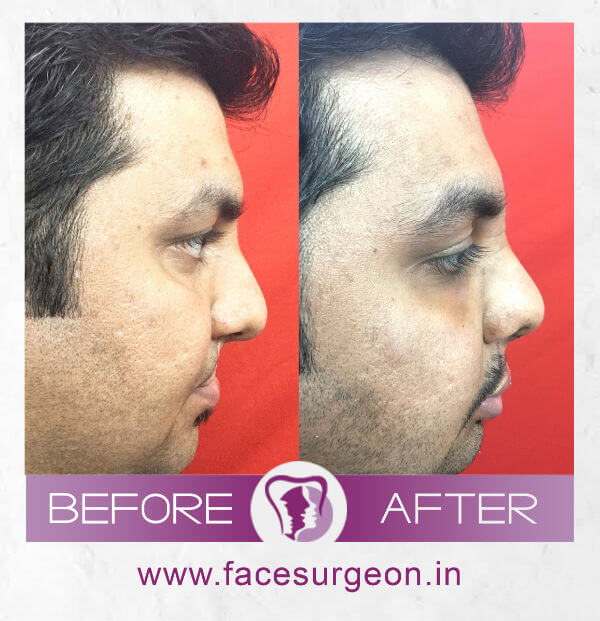 Before and After image of Lip Revision – Left Side View