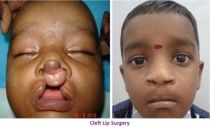Cleft Lip Correction in Nagercoil