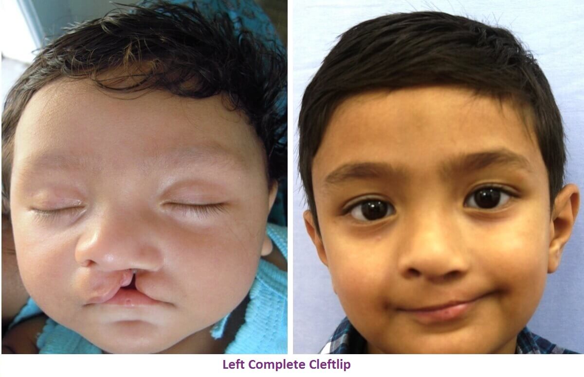 Cleft Lip Surgery