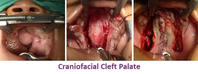 Cleft Palate Surgery