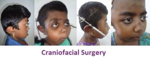 Craniofacial Treatment in Tamil Nadu