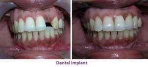 Dental Implant Treatment in Nagercoil