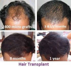 Hair Transplant Treatment in India