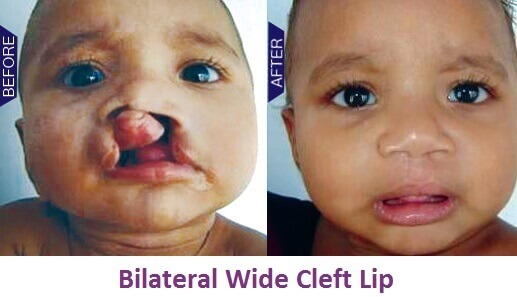 Cleft Lip Surgery