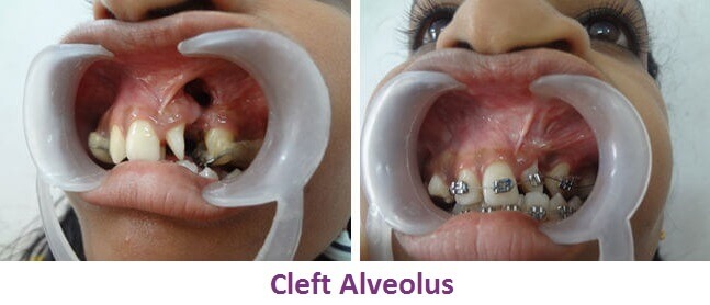Cleft Alveolus