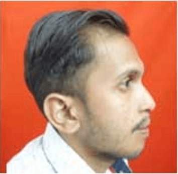 After retrognathic maxilla treatment in india