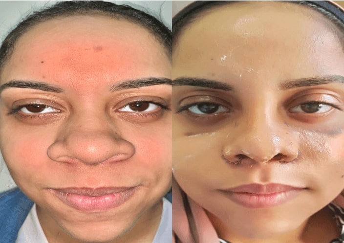 Before and after cleft lip rhinoplasty surgery in india