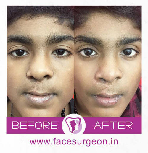 Cleft Lip Surgery Before and After Image