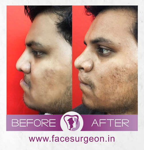 Cleft Lip Surgery at Richardons Hospital Nagercoil, India