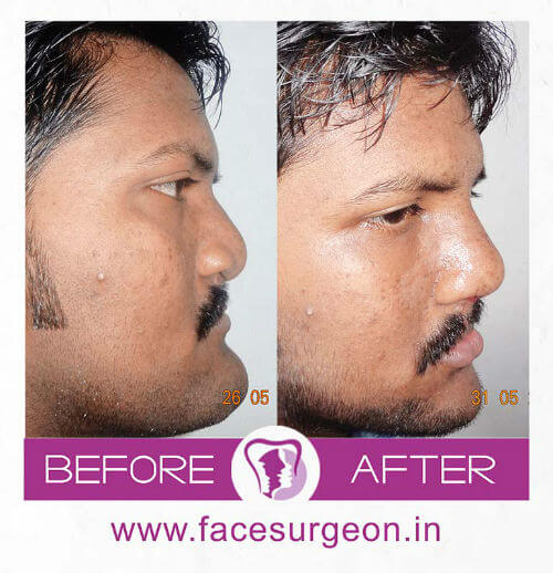 Cleft Lip Surgery at Richardsons Hospital India
