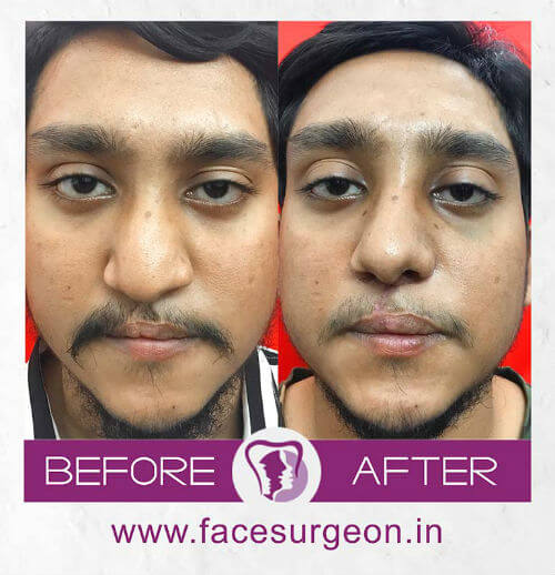 Cleft Lip Surgery before and after picture in India