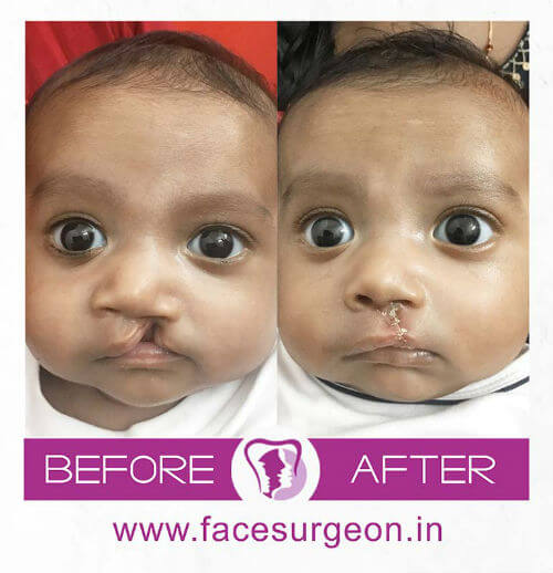 Cleft Lip Surgery for Baby in India