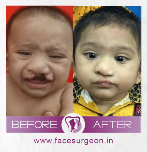 Cleft Lip Surgery in India