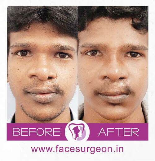 Cleft Rhinoplasty Surgery in India