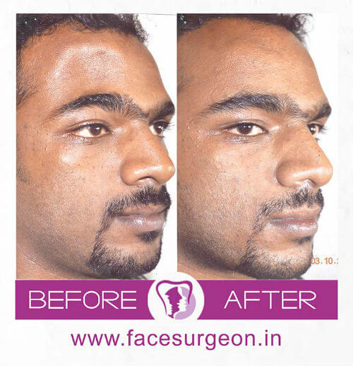 Facemakeover at Richardsons Hospital India