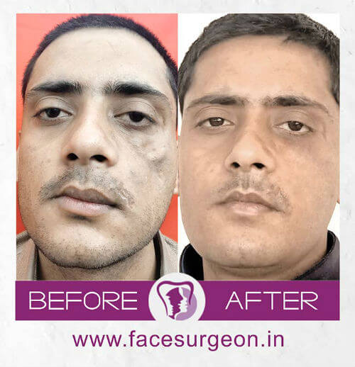Facial Surgery for Man in India