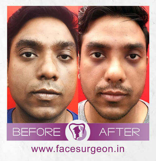 Nose Surgery at Richardsons Hospital India