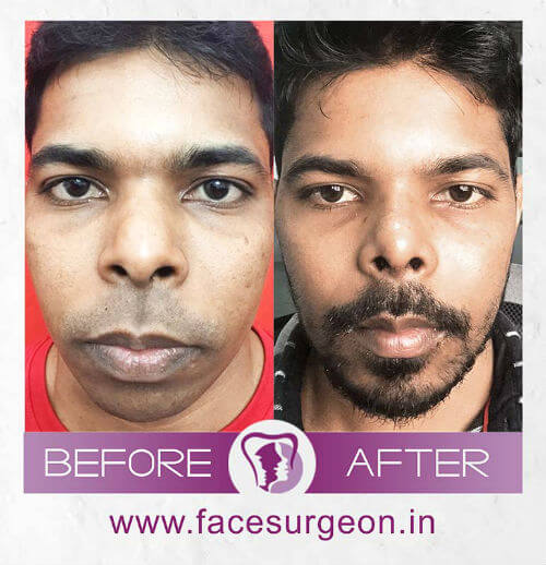 Nose Surgery in India