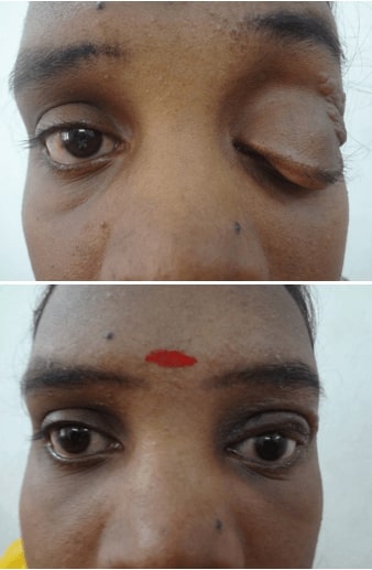 Oculoplastic surgery in india