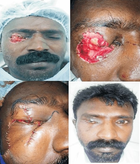 Oculoplasty surgery in india