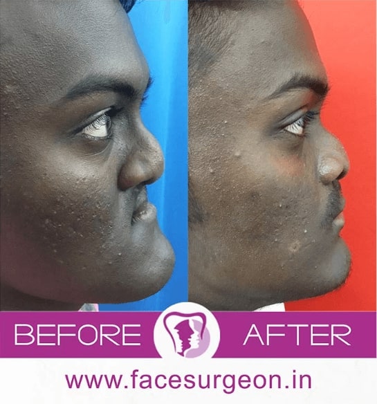 before and after retrognathic maxilla surgery india