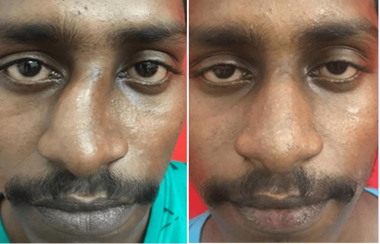 before after cleft lip rhinoplasty in india