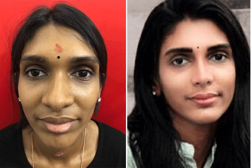before and after rhinoplasty surgeon in india