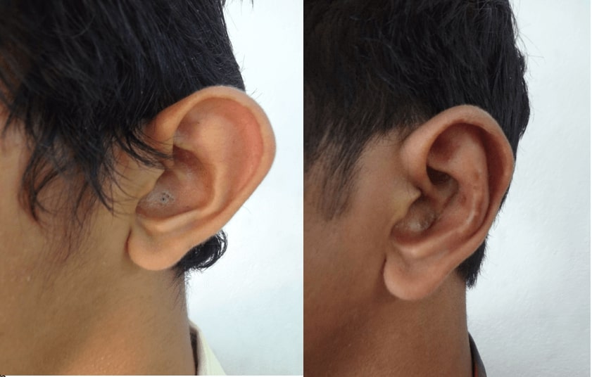 Richardson Hospital The Best Place For Plastic Ear Surgery In India