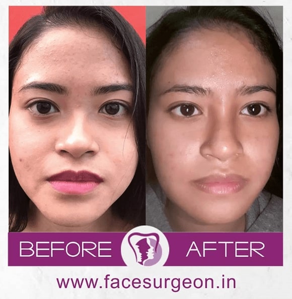 cleft rhinoplasty treatment in india
