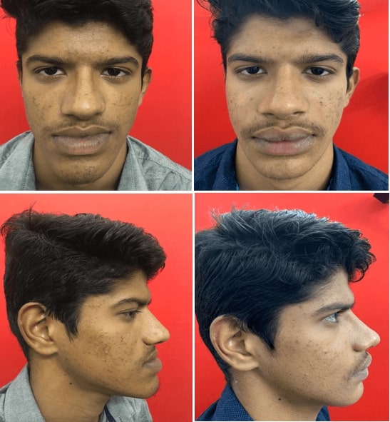corrective jaw surgery in india