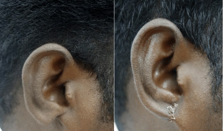 ear plastic surgery in india