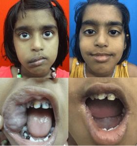 before and after hemangioma treatment in india