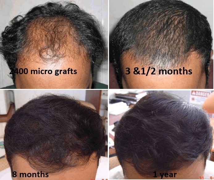 hair transplantation treatment in india