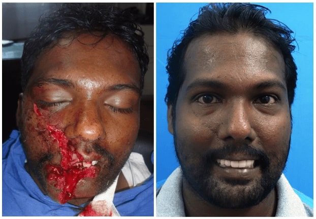 maxillofacial trauma surgery in india