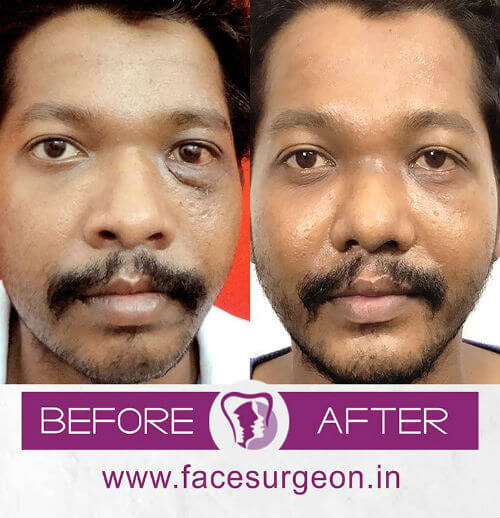 occuloplasty surgery in india
