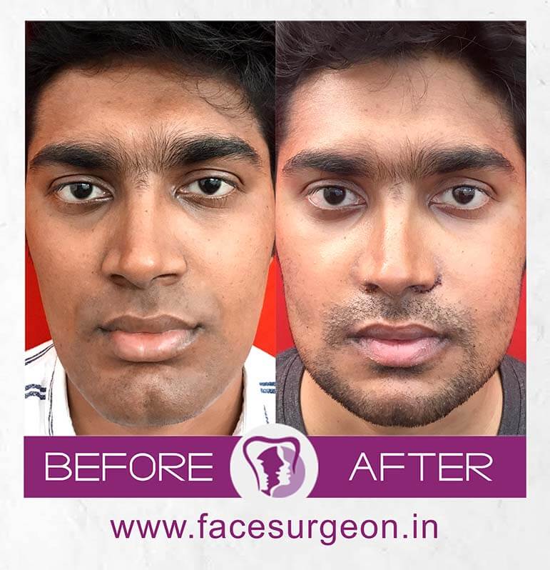 orthognathic jaw surgery in india