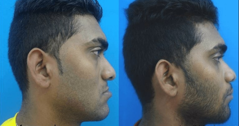 retrognathic maxilla surgery india