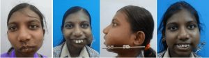 temporomandibular joint surgery in india