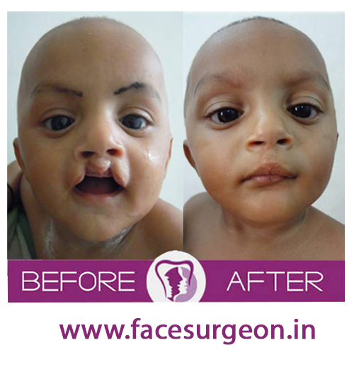 Child Cleft lip surgery at richardsons hospital
