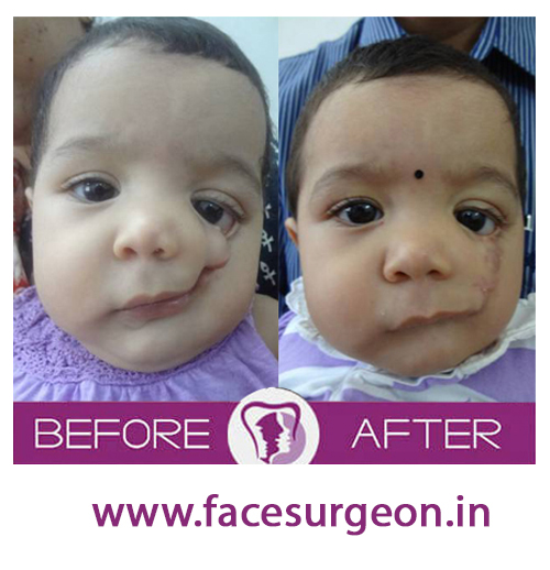 Child cleft palate surgery in india
