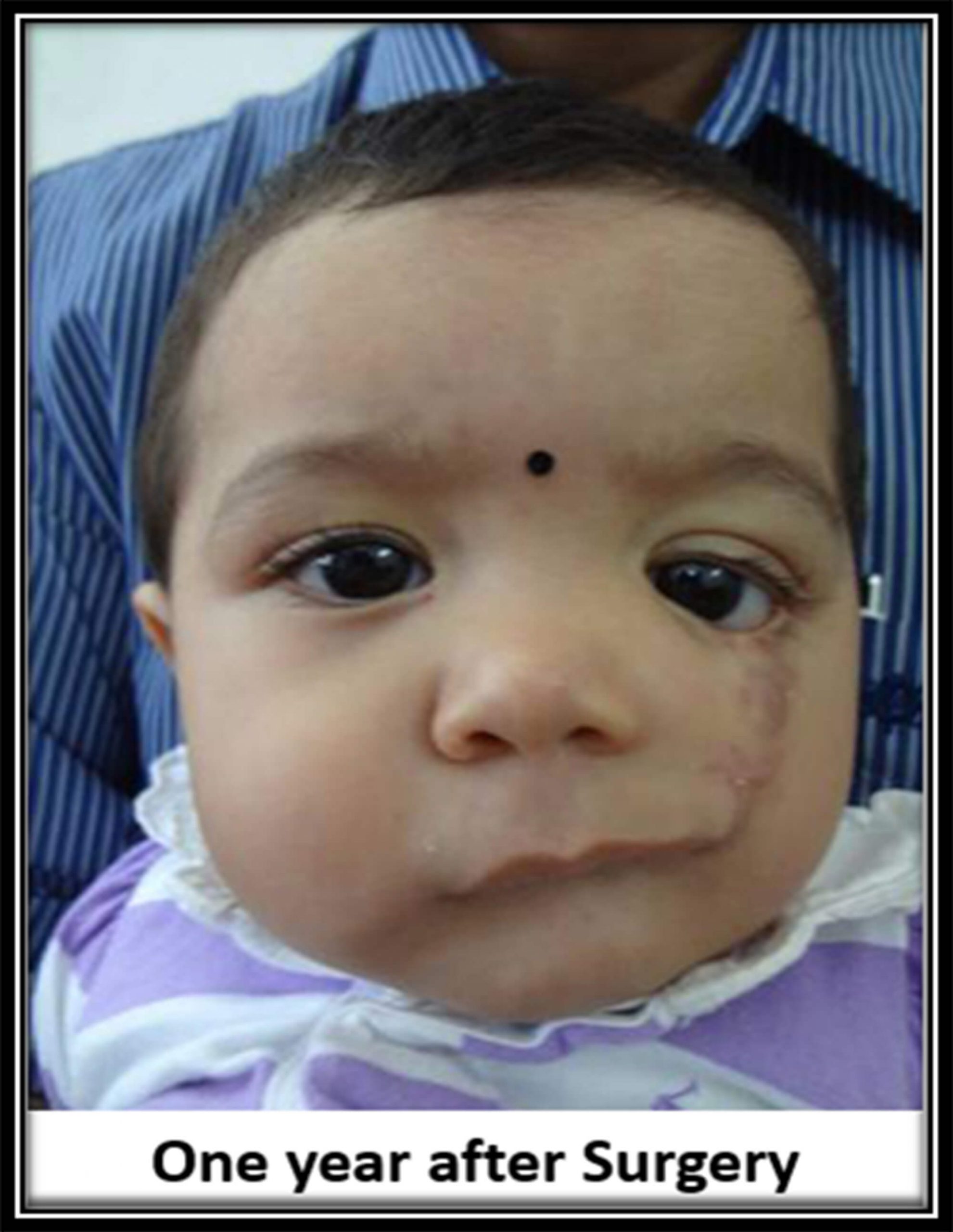 Cleft lip surgery after one year