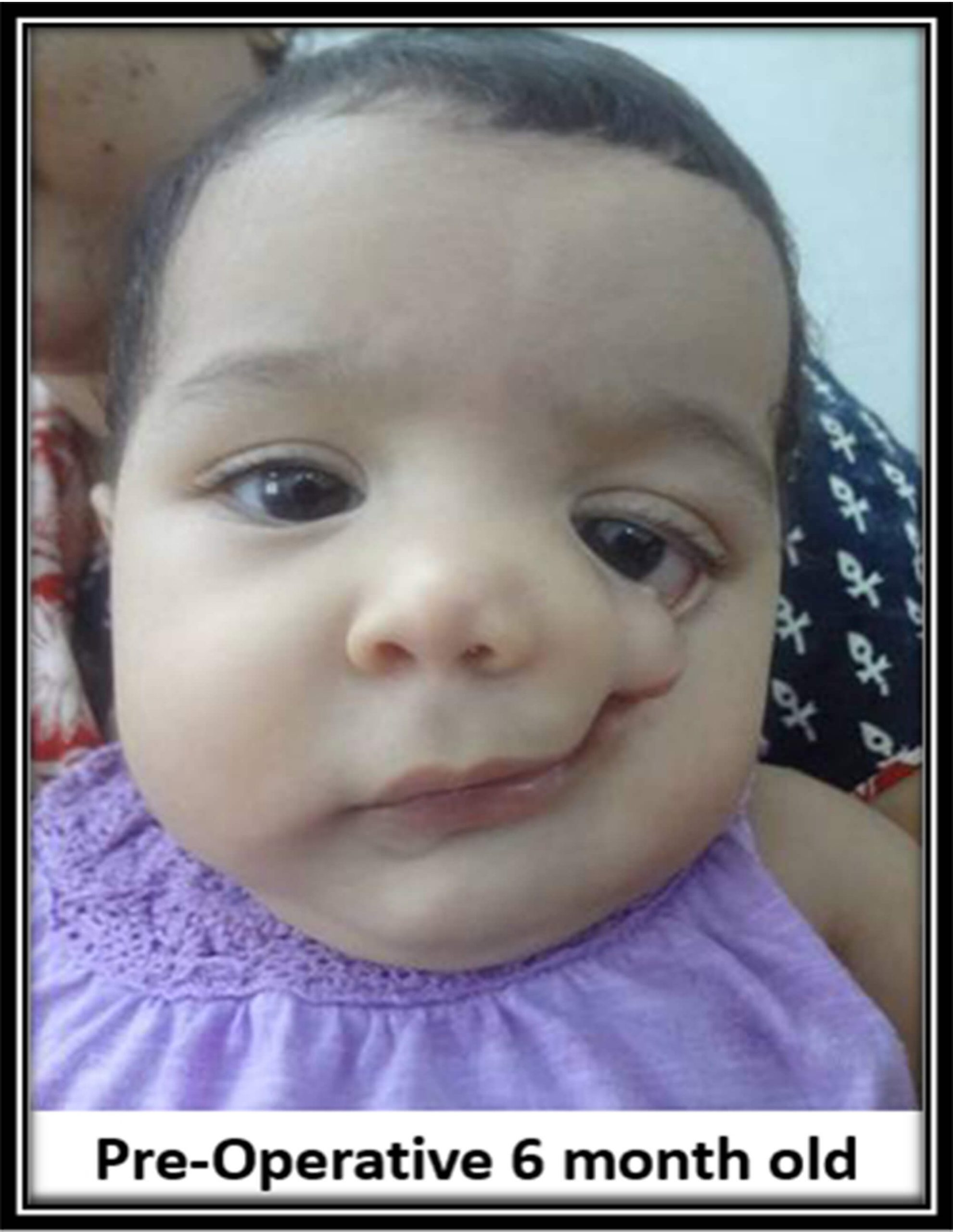 Cleft lip surgery six month old baby