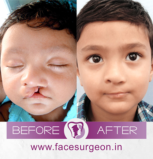 Cleft palate treatment in india