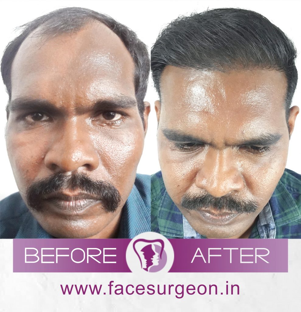 Hair transplant surgery cost in india